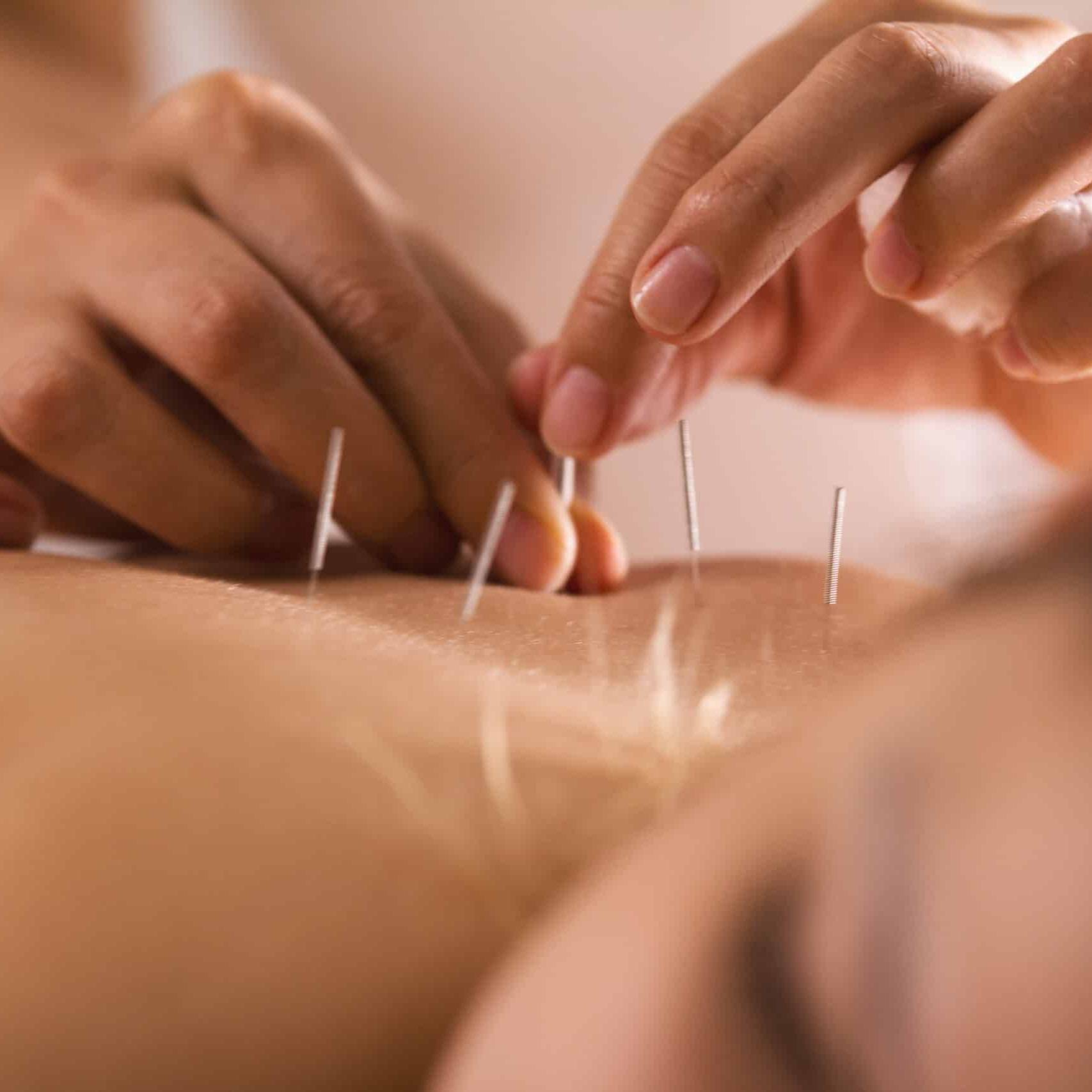 Akupunktur Nadeln H&auml;nde R&uuml;cken